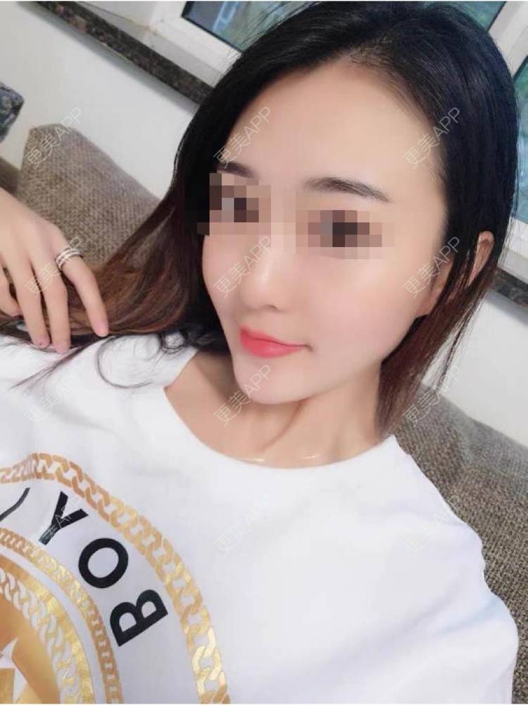 更美 - 更美用户8nX7eyJdyA的除皱经验 | 除皱 | 长沙
