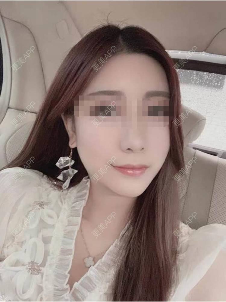 更美 - 喵哼蔽的除皱经验 | 除皱 | 长沙