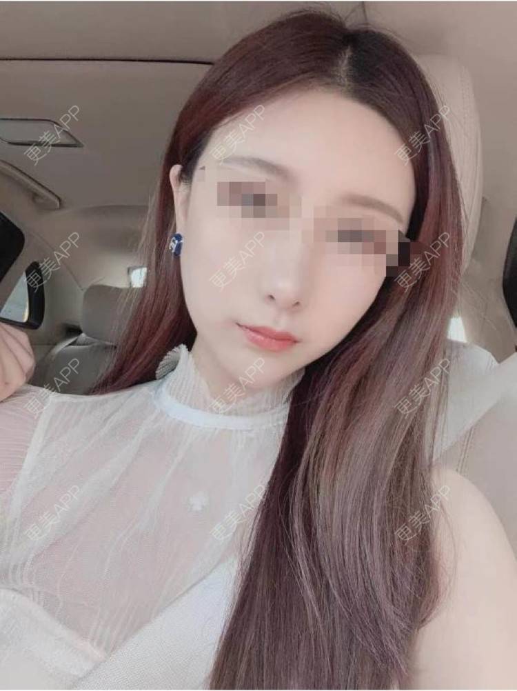 更美 - 喵哼蔽的除皱经验 | 除皱 | 长沙