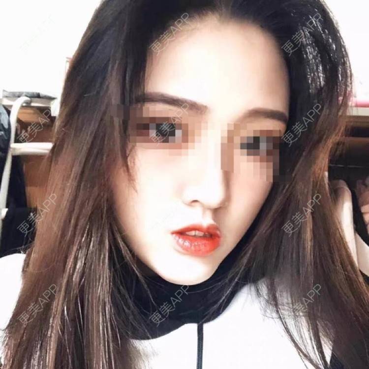 更美 - 更美用户lMpHUEtjrC的除皱经验 | 除皱 | 长沙