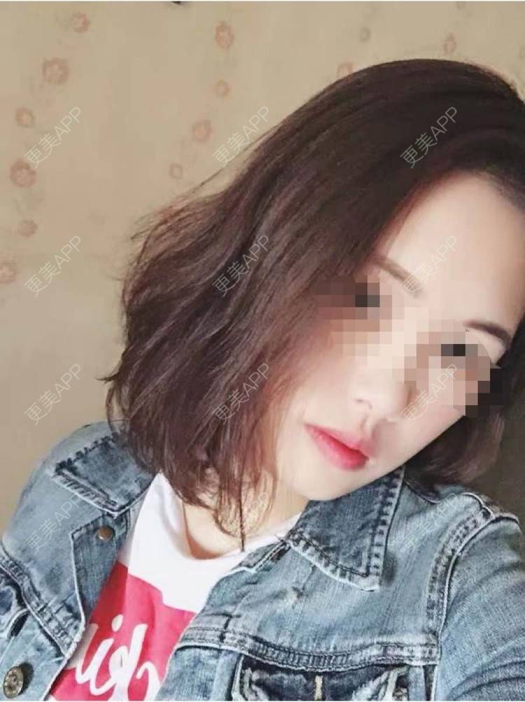 更美 - ×叚裝мо生る¤盏的除皱经验 | 除皱 | 长沙
