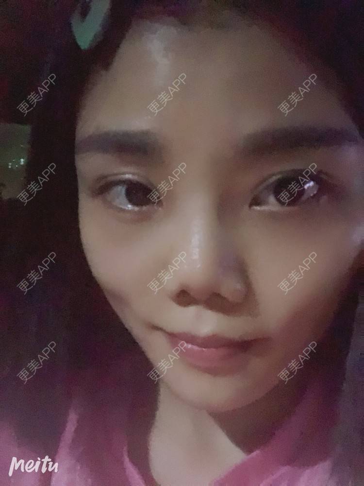 更美 - 艺韩的眶隔脂肪释放经验 | 重庆 | 眶隔脂肪释放