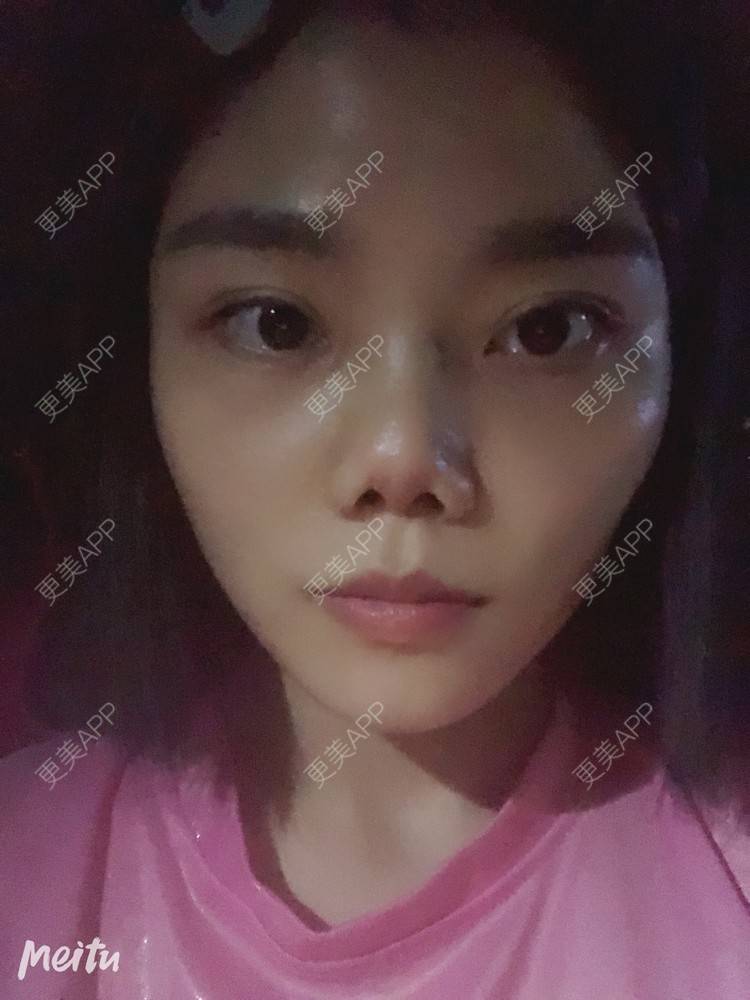 更美 - 艺韩的眶隔脂肪释放经验 | 重庆 | 眶隔脂肪释放