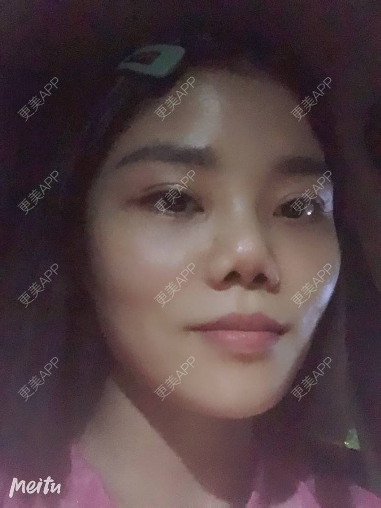 更美 - 艺韩的眶隔脂肪释放经验 | 重庆 | 眶隔脂肪释放