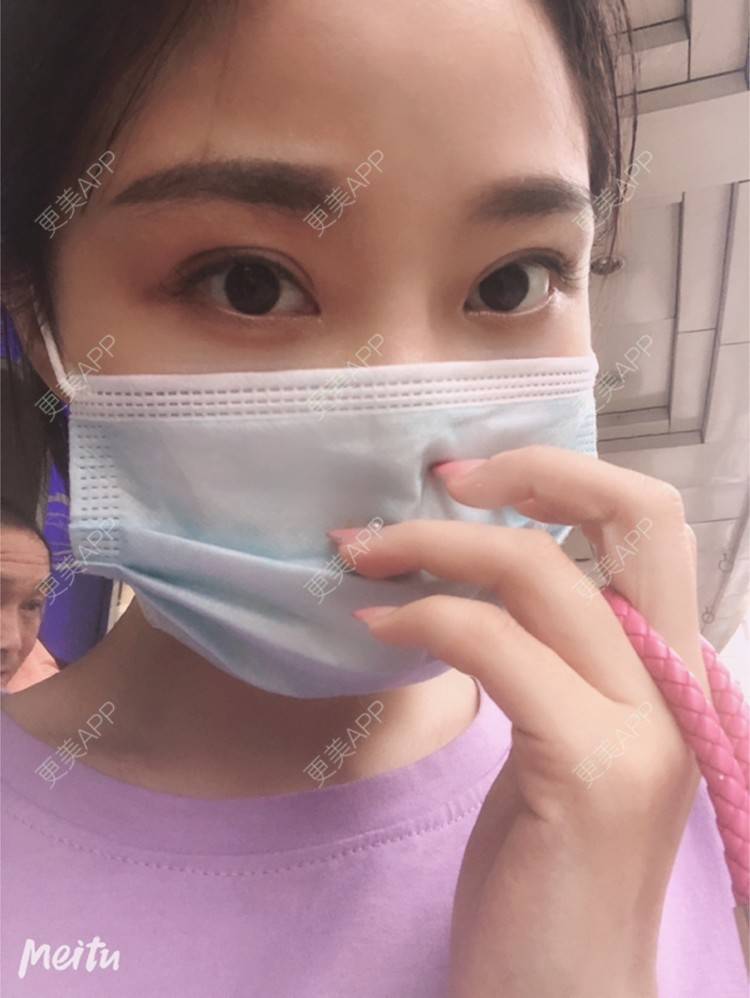 更美 - 艺韩的眶隔脂肪释放经验 | 重庆 | 眶隔脂肪释放