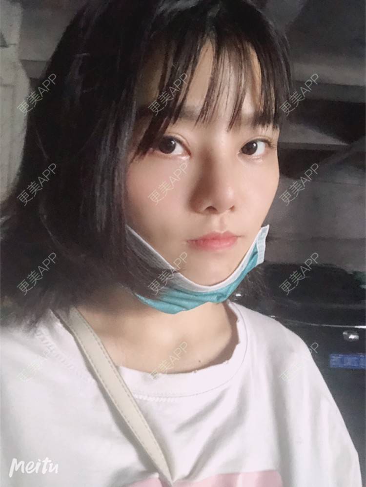 更美 - 艺韩的眶隔脂肪释放经验 | 重庆 | 眶隔脂肪释放