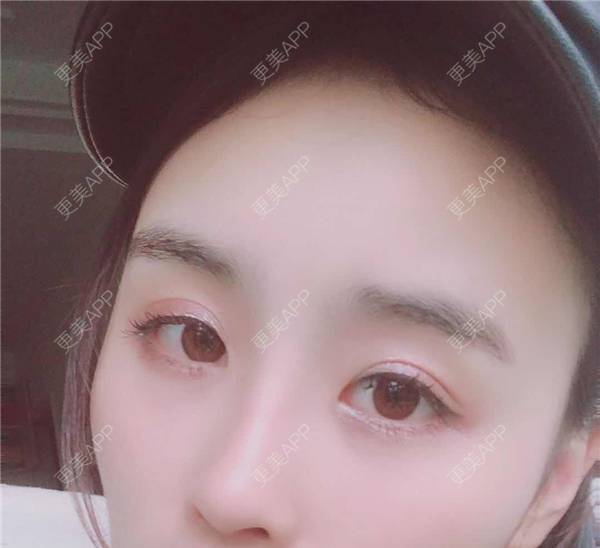 更美 - 更美用户aM5lHGUj1o的自体脂肪全面部填充经验 | 自体脂肪全面部填充 | 视频日记 | 重庆 | 额头