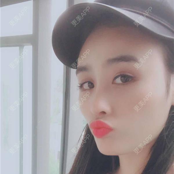 更美 - 更美用户aM5lHGUj1o的自体脂肪全面部填充经验 | 自体脂肪全面部填充 | 视频日记 | 重庆 | 额头