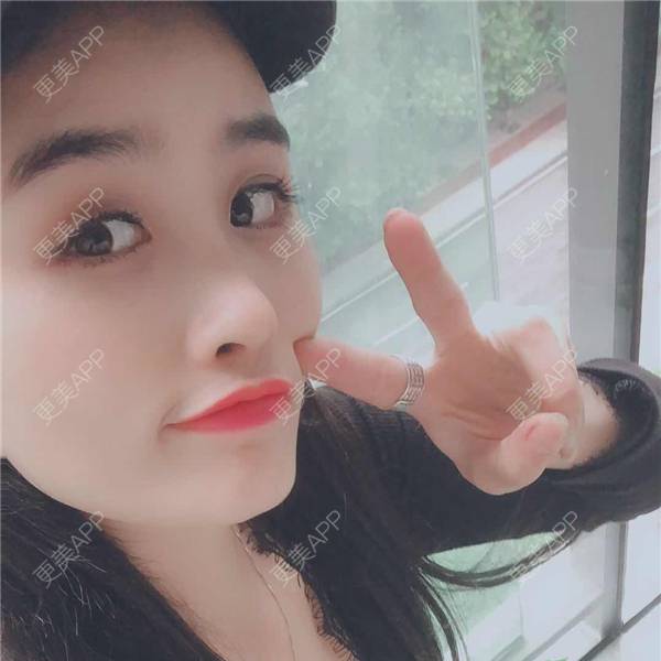 更美 - 更美用户aM5lHGUj1o的自体脂肪全面部填充经验 | 自体脂肪全面部填充 | 视频日记 | 重庆 | 额头