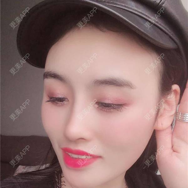 更美 - 更美用户aM5lHGUj1o的自体脂肪全面部填充经验 | 自体脂肪全面部填充 | 视频日记 | 重庆 | 额头