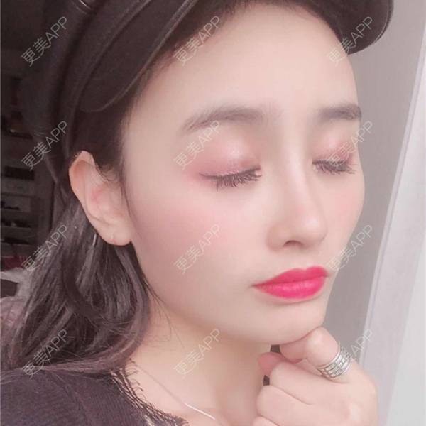 更美 - 更美用户aM5lHGUj1o的自体脂肪全面部填充经验 | 自体脂肪全面部填充 | 视频日记 | 重庆 | 额头