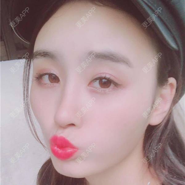 更美 - 更美用户aM5lHGUj1o的自体脂肪全面部填充经验 | 自体脂肪全面部填充 | 视频日记 | 重庆 | 额头