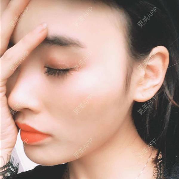 更美 - 更美用户aM5lHGUj1o的自体脂肪全面部填充经验 | 自体脂肪全面部填充 | 视频日记 | 重庆 | 额头
