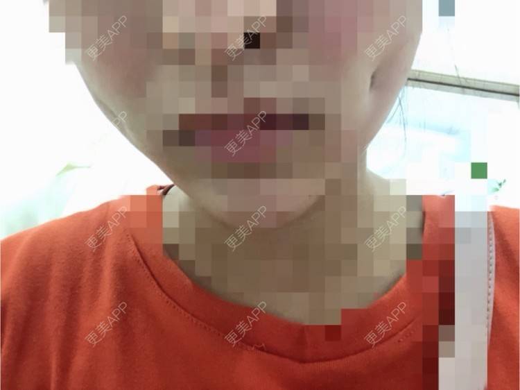 更美 - 🌊里个🌊的酒窝成形经验 | 酒窝成形 | 珠海