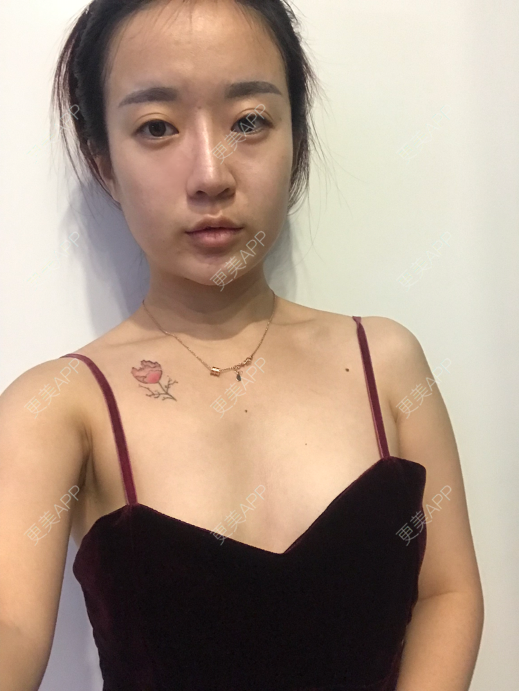 只做明媚的女人履的假体隆胸日记