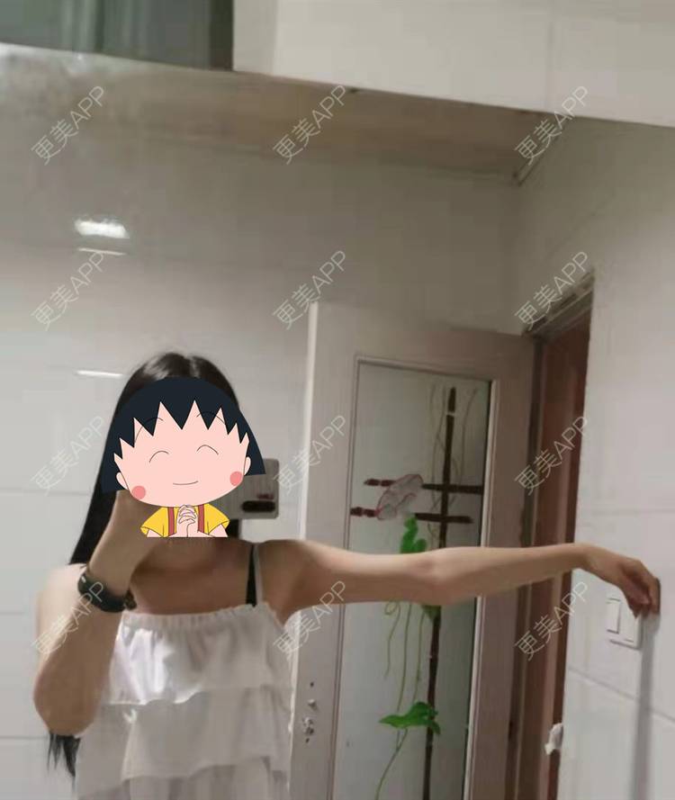 更美 - 更美用户jHjijlJNxV的手臂吸脂经验 | 手臂吸脂 | 广州