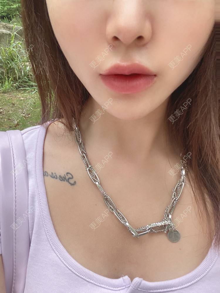 更美 - YU大喵🌈miss的玻尿酸唇部经验 | 玻尿酸唇部 | 成都 | 玻尿酸