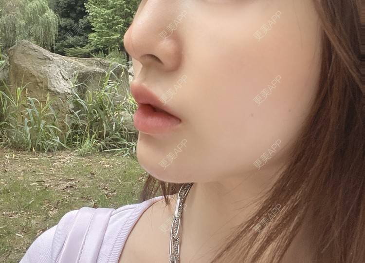 更美 - YU大喵🌈miss的玻尿酸唇部经验 | 玻尿酸唇部 | 成都 | 玻尿酸