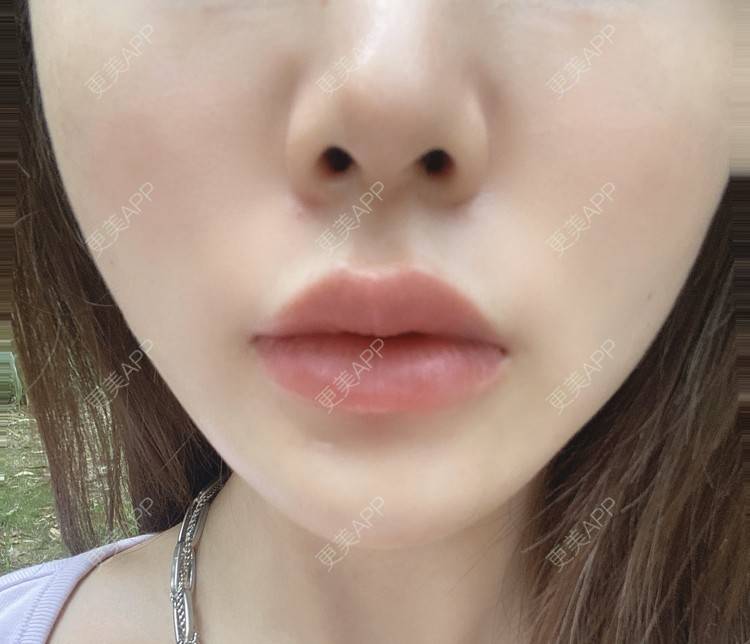 更美 - YU大喵🌈miss的玻尿酸唇部经验 | 玻尿酸唇部 | 成都 | 玻尿酸
