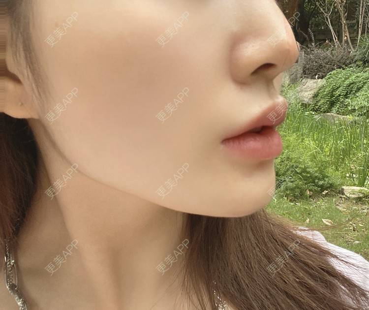 更美 - YU大喵🌈miss的玻尿酸唇部经验 | 玻尿酸唇部 | 成都 | 玻尿酸