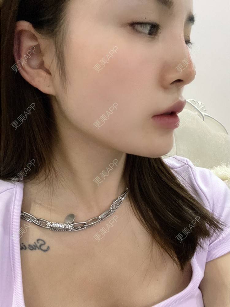 更美 - YU大喵🌈miss的玻尿酸唇部经验 | 玻尿酸唇部 | 成都 | 玻尿酸