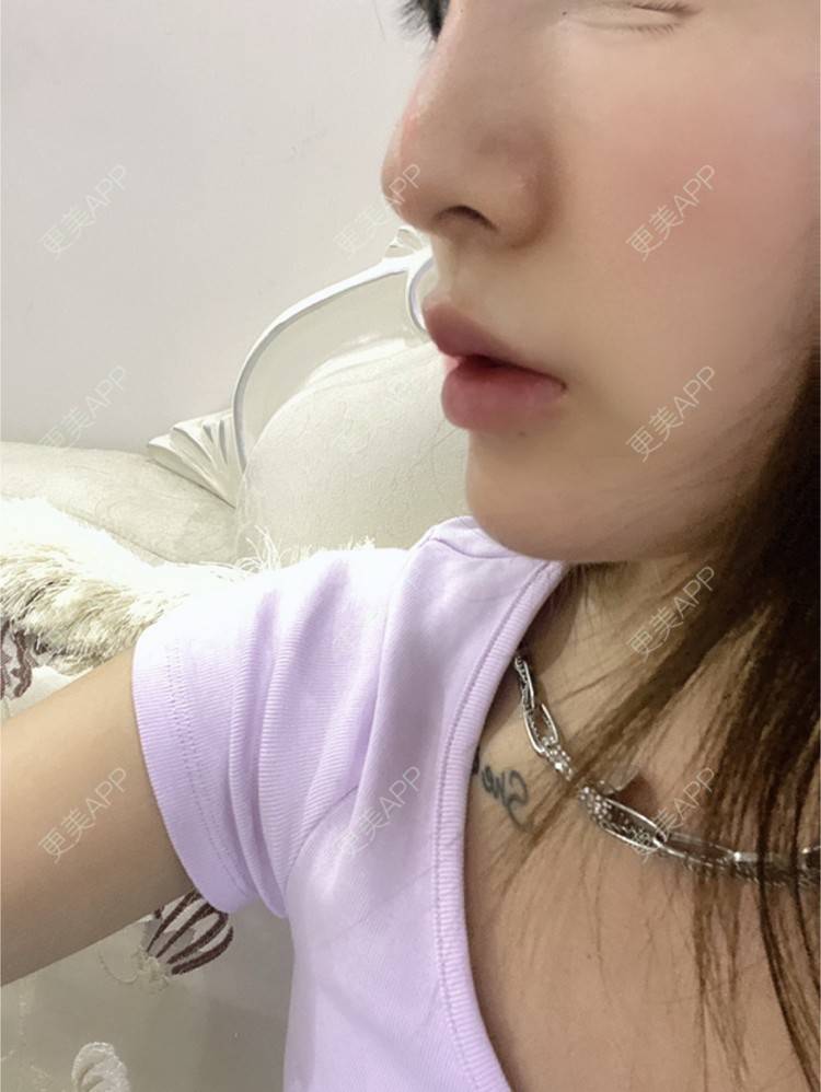 更美 - YU大喵🌈miss的玻尿酸唇部经验 | 玻尿酸唇部 | 成都 | 玻尿酸