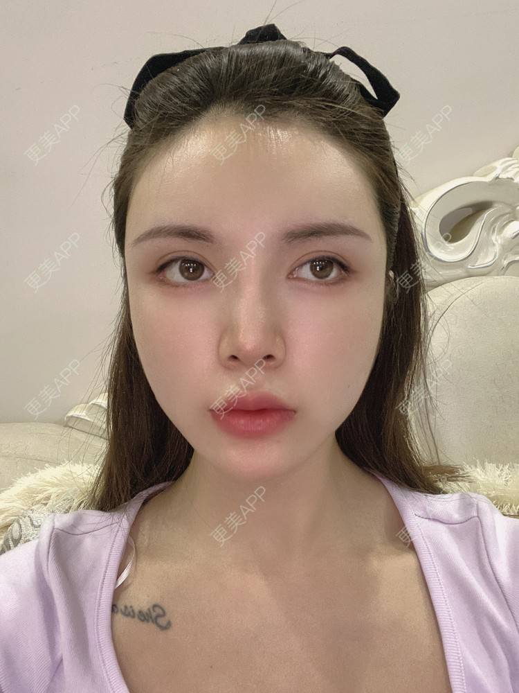 更美 - YU大喵🌈miss的玻尿酸唇部经验 | 玻尿酸唇部 | 成都 | 玻尿酸