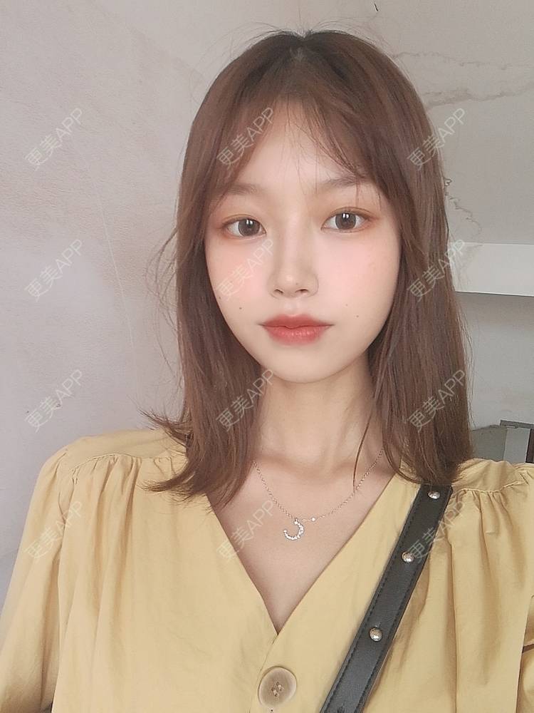 更美 - 不要奶茶的M唇成形经验 | M唇成形 | 杭州