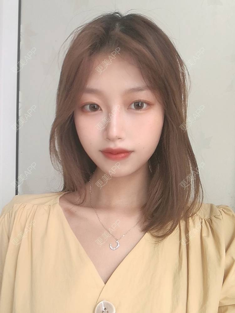 更美 - 不要奶茶的M唇成形经验 | M唇成形 | 杭州