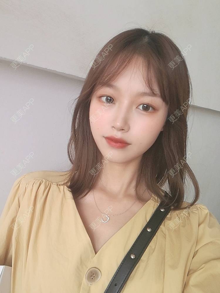 更美 - 不要奶茶的M唇成形经验 | M唇成形 | 杭州