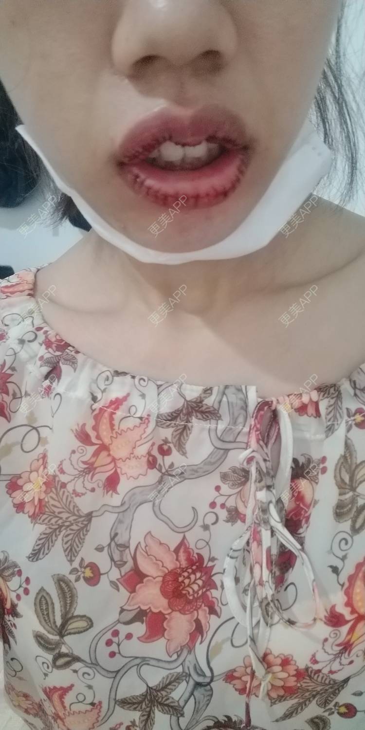 更美 - 更美用户DmKzL6dVHB的M唇成形经验 | 上海 | M唇成形