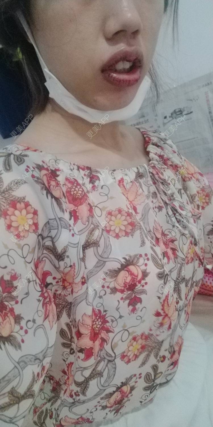 更美 - 更美用户DmKzL6dVHB的M唇成形经验 | 上海 | M唇成形