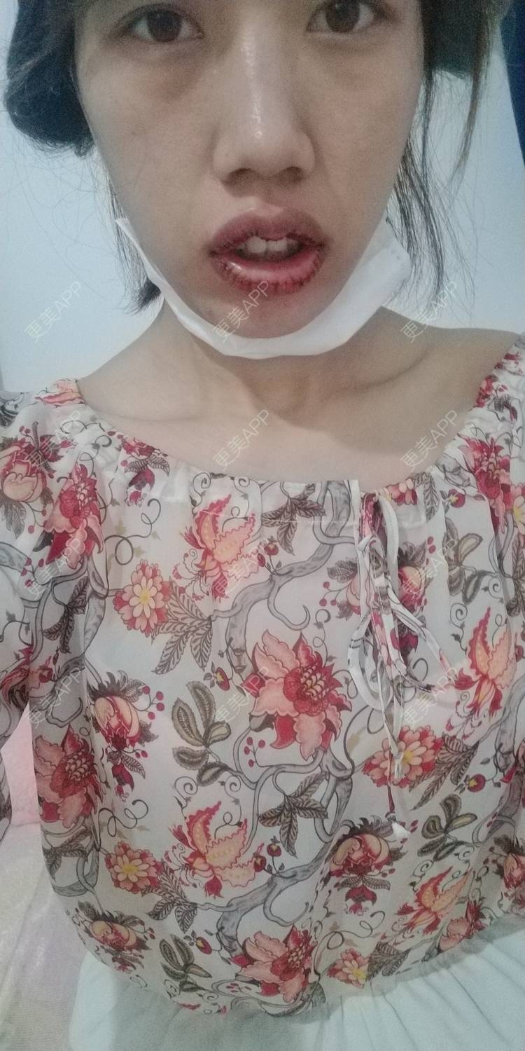 更美 - 更美用户DmKzL6dVHB的M唇成形经验 | 上海 | M唇成形