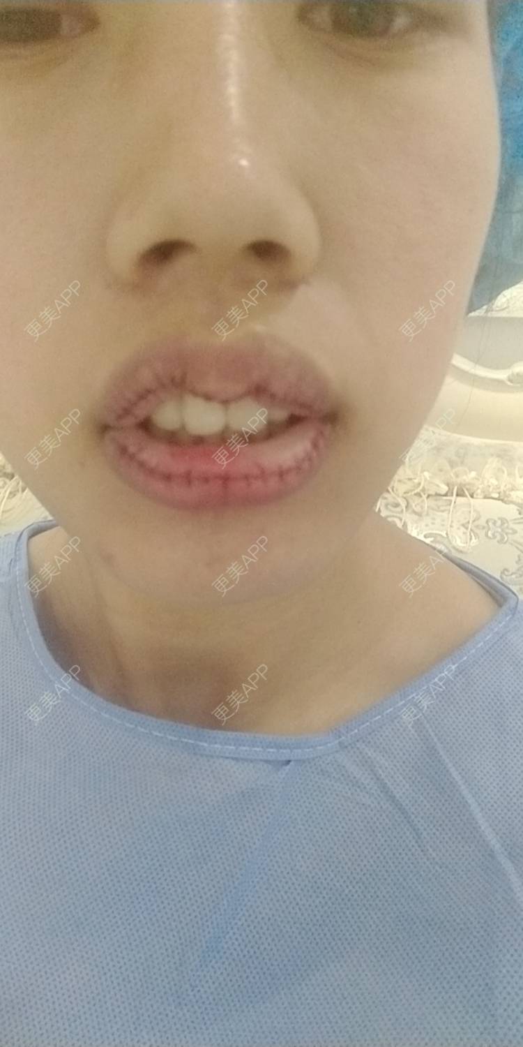 更美 - 更美用户DmKzL6dVHB的M唇成形经验 | 上海 | M唇成形