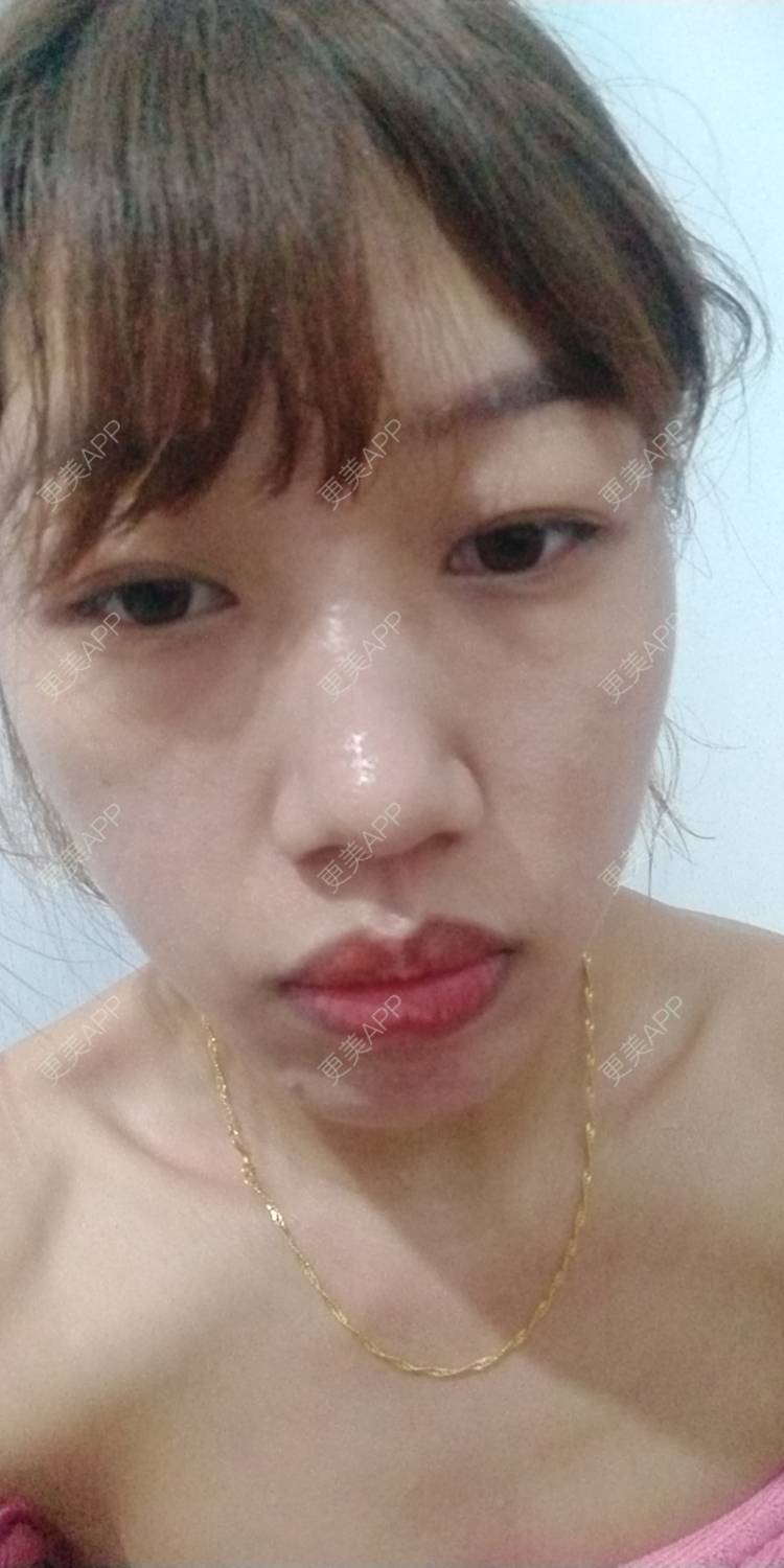 更美 - 更美用户DmKzL6dVHB的M唇成形经验 | 上海 | M唇成形