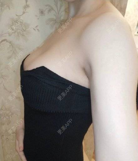 更美 - 执念吖的假体隆胸经验 | 假体隆胸 | 南昌