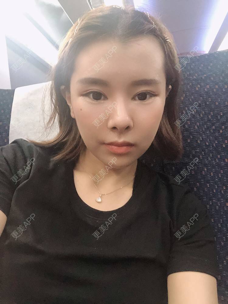 更美 - 更美用户WOuVgkC9NU的颧骨内推经验 | 颧骨内推 | 成都 | 颧弓降低