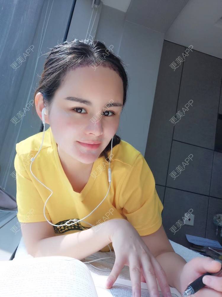 更美 - 博研马可的植发际线经验 | 植发际线 | 广州