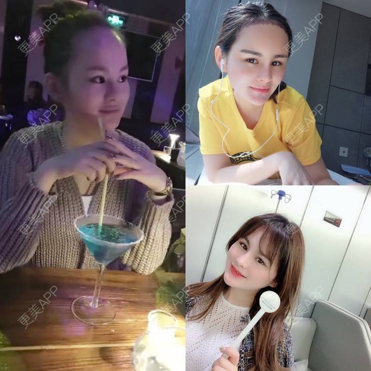 更美 - 博研马可的植发际线经验 | 植发际线 | 广州