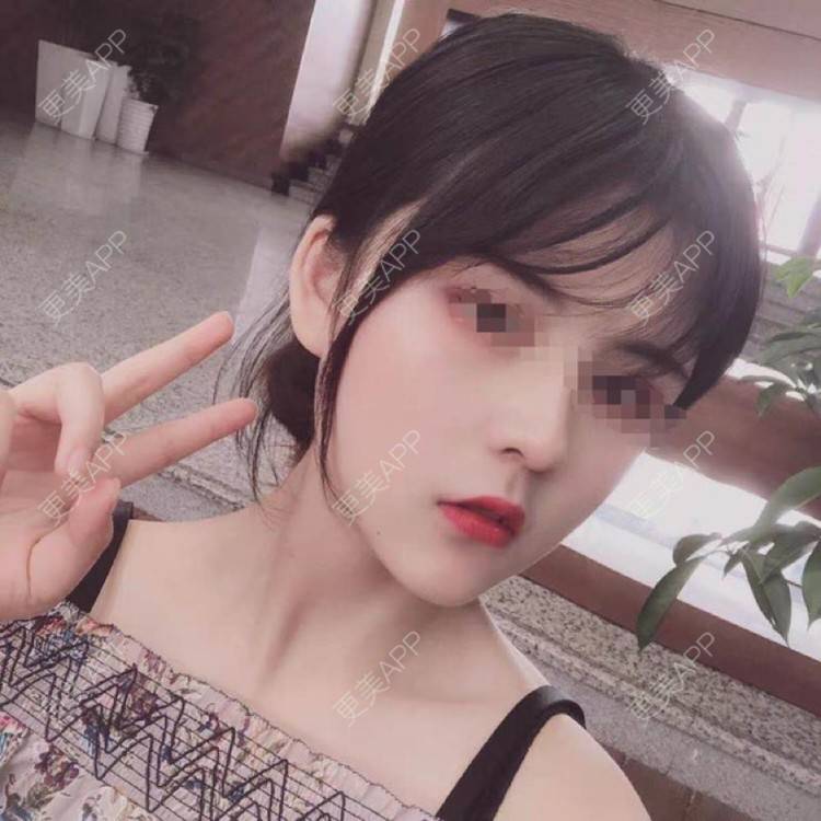 更美 - 爱的十字路口々苫的除皱经验 | 除皱 | 长沙