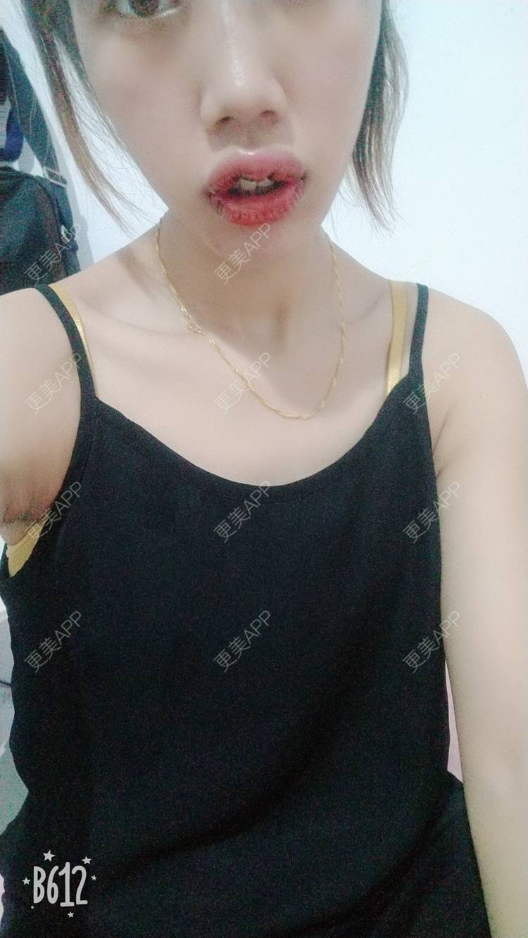 更美 - 更美用户DmKzL6dVHB的M唇成形经验 | 上海 | M唇成形