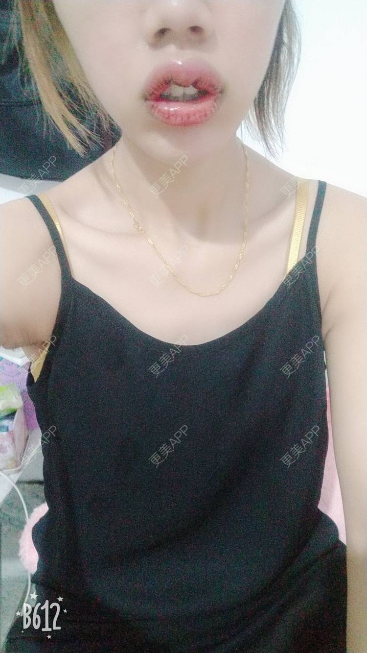 更美 - 更美用户DmKzL6dVHB的M唇成形经验 | 上海 | M唇成形