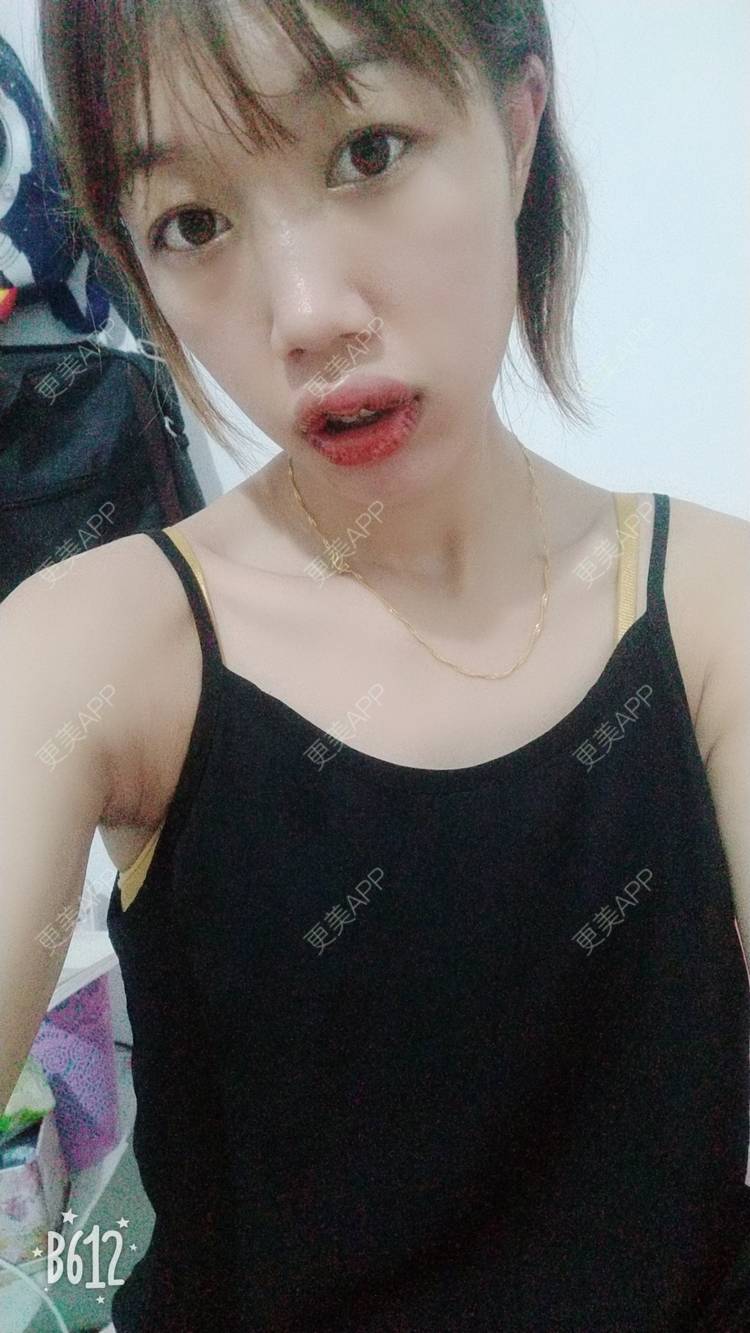 更美 - 更美用户DmKzL6dVHB的M唇成形经验 | 上海 | M唇成形