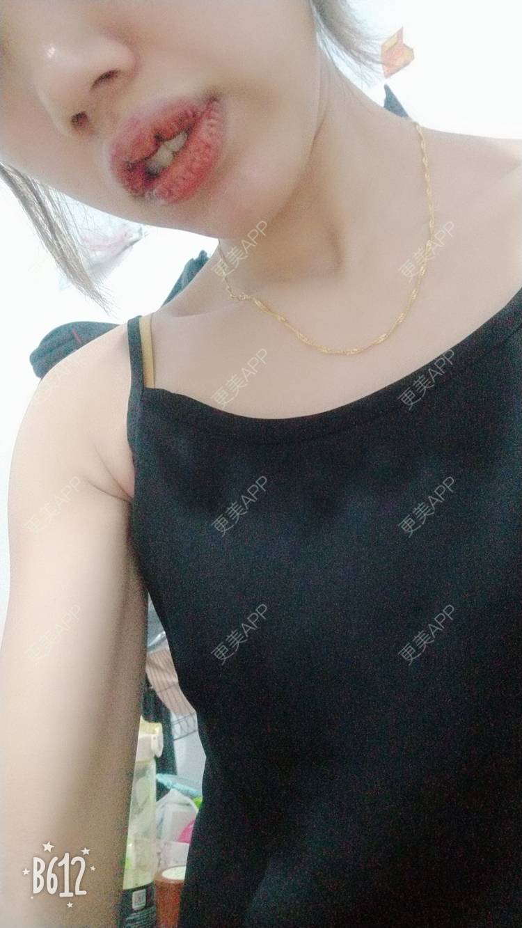 更美 - 更美用户DmKzL6dVHB的M唇成形经验 | 上海 | M唇成形