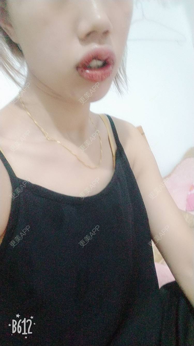 更美 - 更美用户DmKzL6dVHB的M唇成形经验 | 上海 | M唇成形