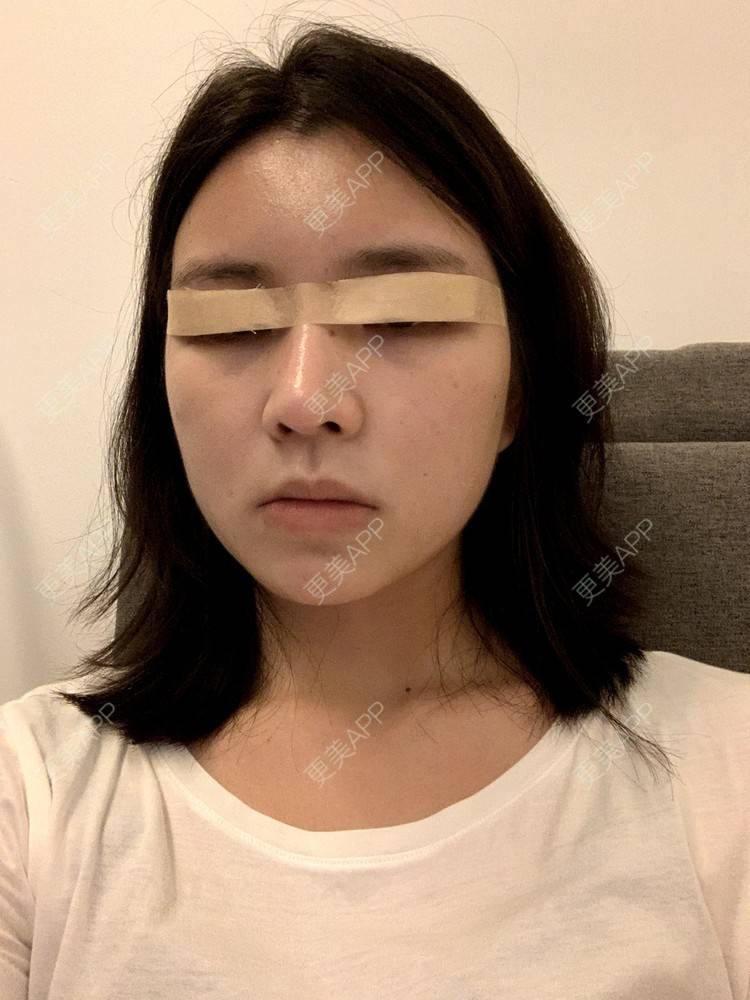 更美 - 更美用户B670A6hUBe的眼部综合经验 | 眼部综合 | 广州
