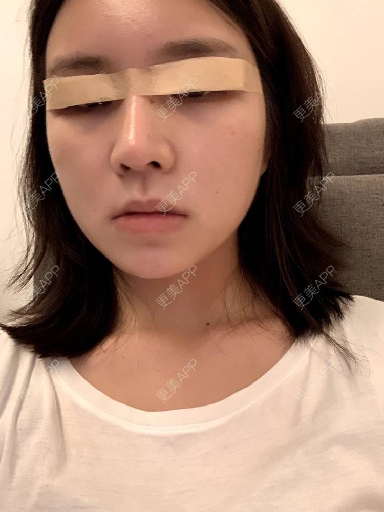 更美 - 更美用户B670A6hUBe的眼部综合经验 | 眼部综合 | 广州