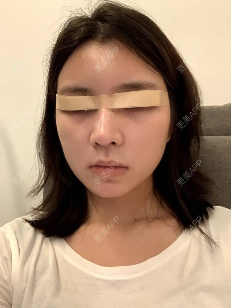 更美 - 更美用户B670A6hUBe的眼部综合经验 | 眼部综合 | 广州