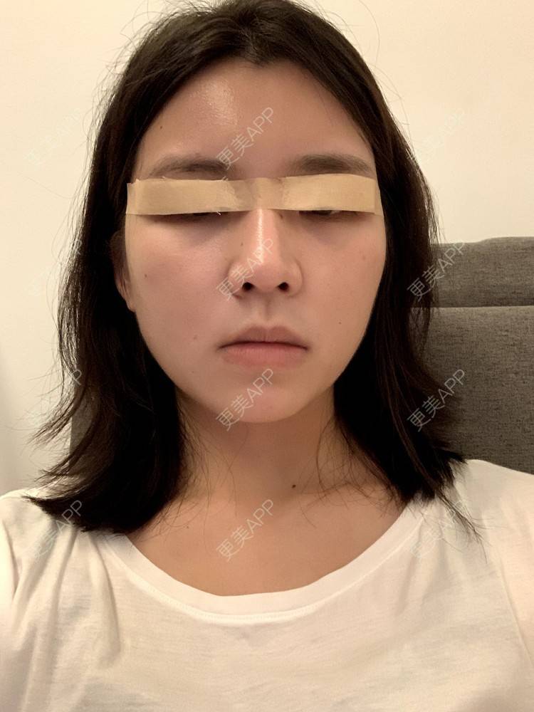更美 - 更美用户B670A6hUBe的眼部综合经验 | 眼部综合 | 广州