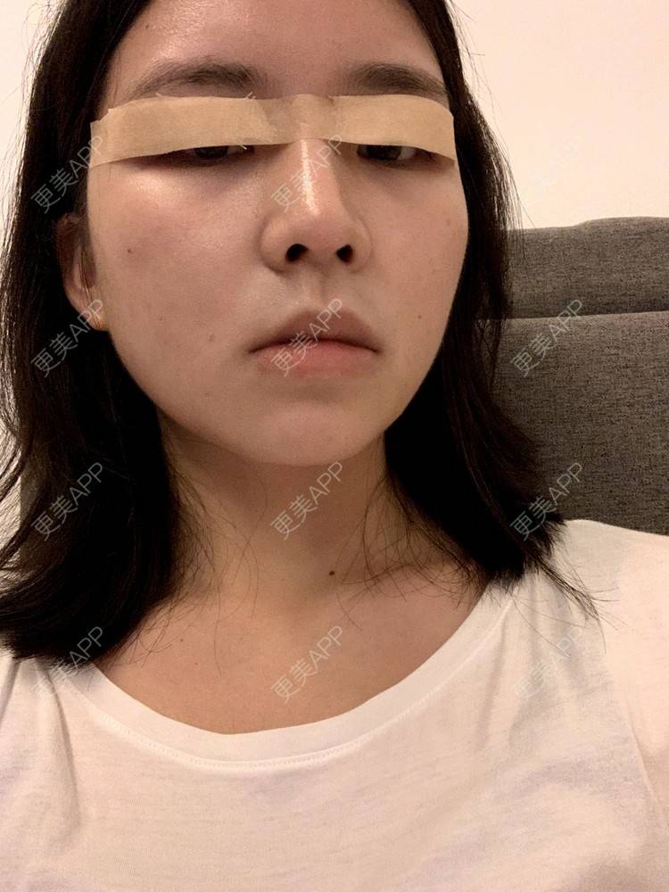 更美 - 更美用户B670A6hUBe的眼部综合经验 | 眼部综合 | 广州